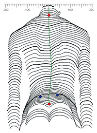3-D Wirbelsäulenvermessung