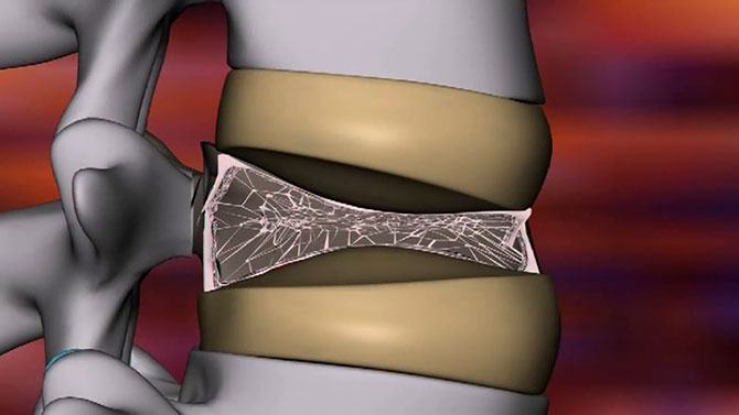 Informationsvideo zum Thema 'Osteoporose'